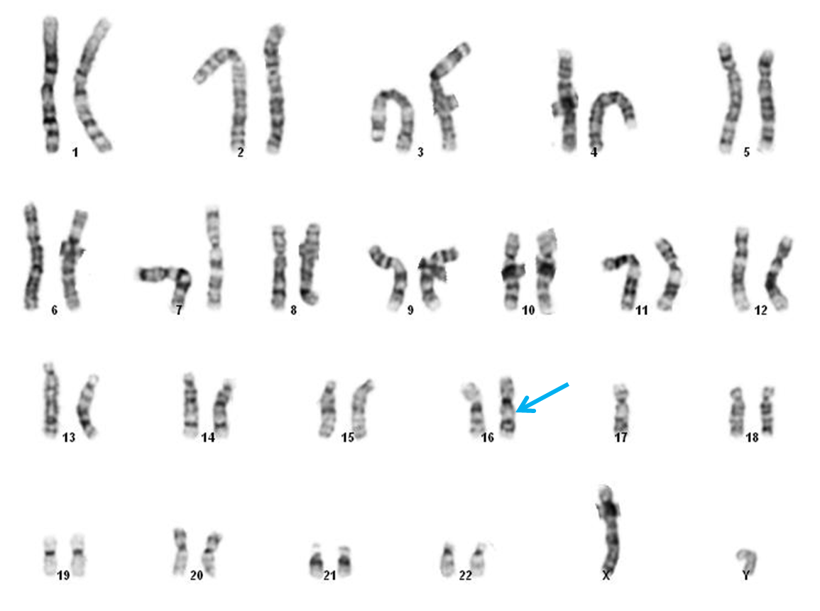 Image 5. Chromosomal study reveals a stem line and multiple side lines. Karyotype: 45,XY,der(16)t(16;17)(q12~13;q11.2),-17[3]/ 46,sl,+11[10]/ 47,sdl1,+9,+11[2] 47,sdl2,+11,+13[2] 46,XY[3]